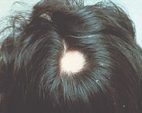 alopecia aerata